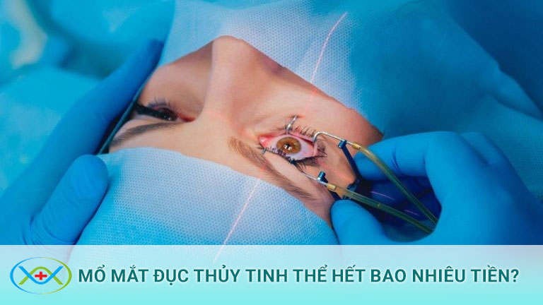 Mổ mắt đục thủy tinh thể hết bao nhiêu tiền?