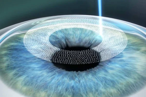 quy-trinh-chieu-laser-excimer-dieu-tri-can-thi-femto-lasik